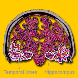 Temporal lobes